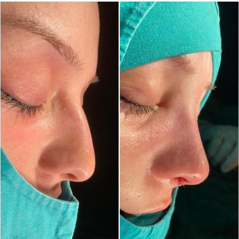 Rinoplasti öncesi ve sonrası, klinik arşivi