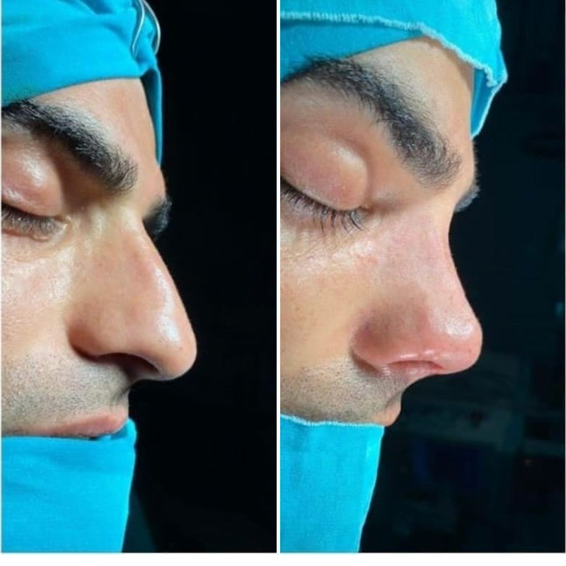 Rinoplasti öncesi ve sonrası, klinik arşivi