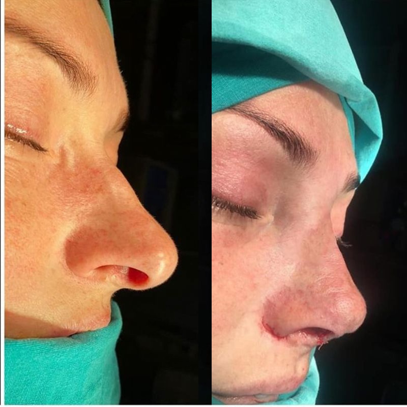 Rinoplasti öncesi ve sonrası, klinik arşivi